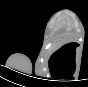 Adult female Breast Test Phantom CT, useful for mammogram testing