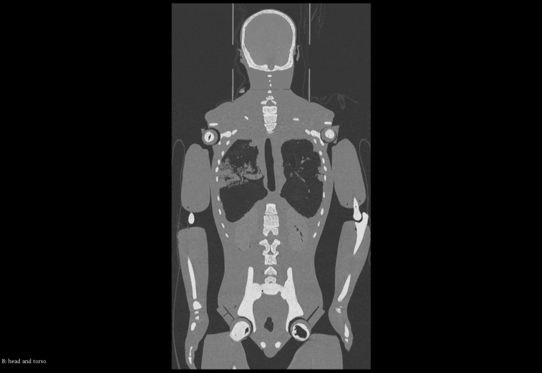 CT scan for Phantom for X-Ray, CT, MRI