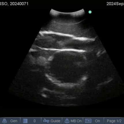 Ultrasound Scan for FAST Torso from TPS