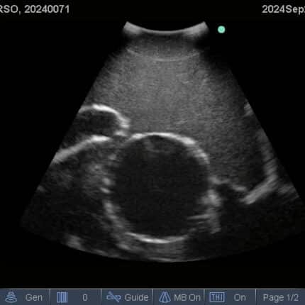 Ultrasound Scan for FAST Torso from TPS