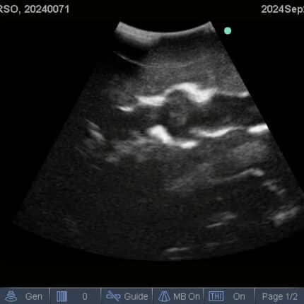 Ultrasound Scan for FAST Torso from TPS