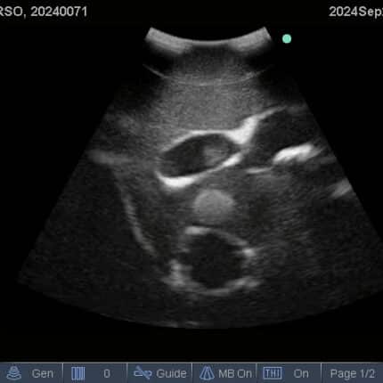 Ultrasound Scan for FAST Torso from TPS