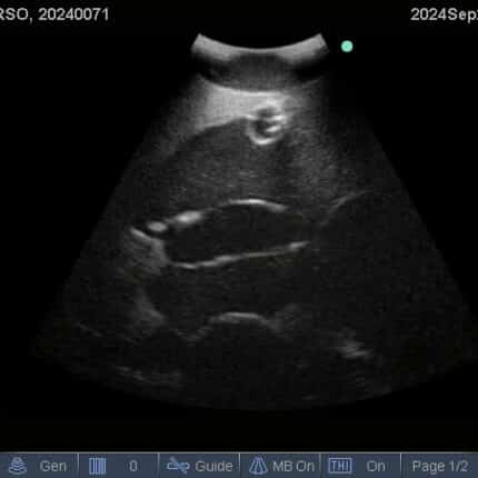 Ultrasound Scan for FAST Torso from TPS