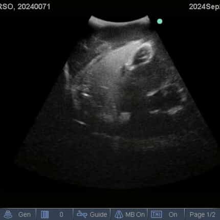 Ultrasound Scan for FAST Torso from TPS