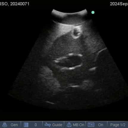 Ultrasound Scan for FAST Torso from TPS