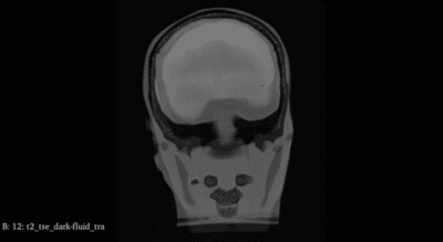 Head Scan MRI for FB-A02