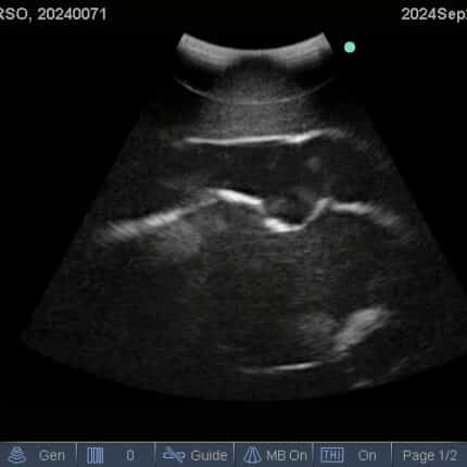 Ultrasound Scan for FAST Torso from TPS