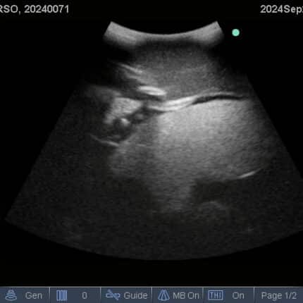 Ultrasound Scan for FAST Torso from TPS