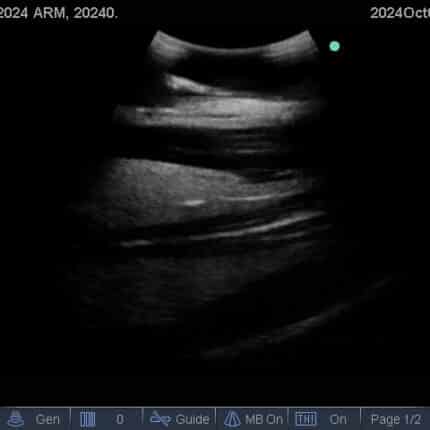 Advanced Arm Ultrasound Phantom