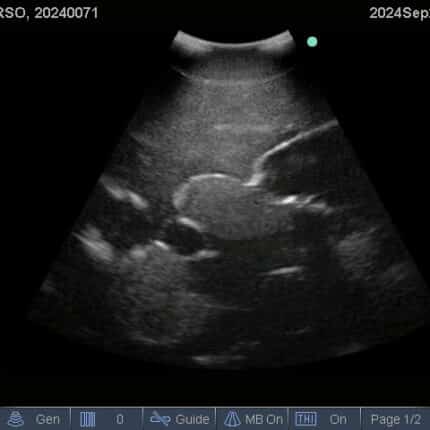 Ultrasound Scan for FAST Torso from TPS