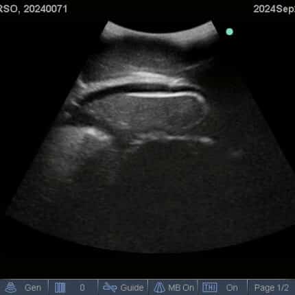 Ultrasound Scan for FAST Torso from TPS