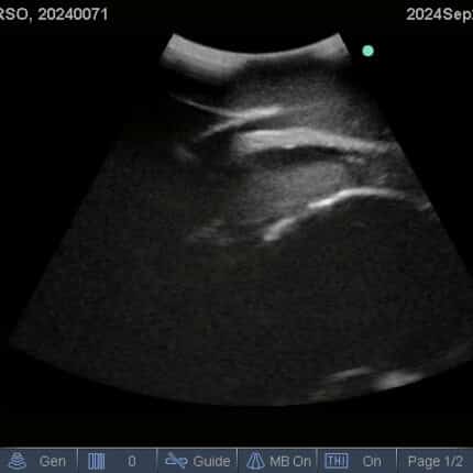 Ultrasound Scan for FAST Torso from TPS