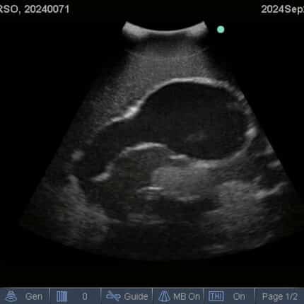 Ultrasound Scan for FAST Torso from TPS