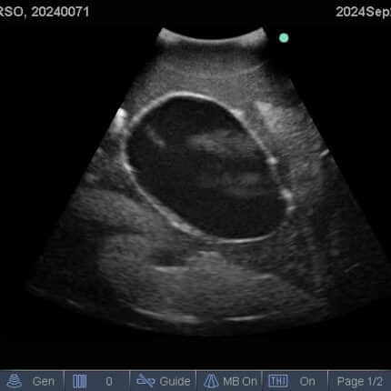 Ultrasound Scan for FAST Torso from TPS