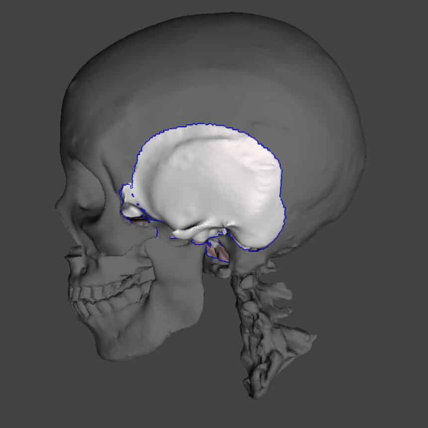 Temporal bone Visualisation