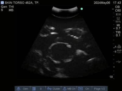 Ultrasound scan of Skin Torso Phantom from True Phantom Solutions