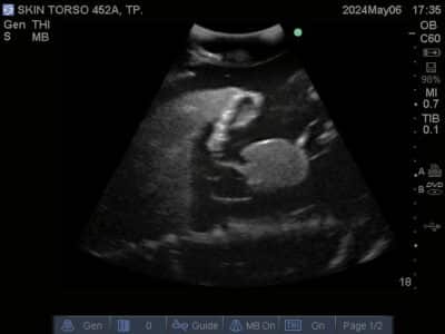 Ultrasound scan of Skin Torso Phantom from True Phantom Solutions