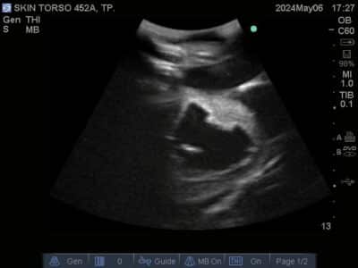 Ultrasound scan of Skin Torso Phantom from True Phantom Solutions