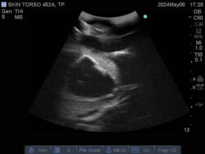 Ultrasound scan of Skin Torso Phantom from True Phantom Solutions