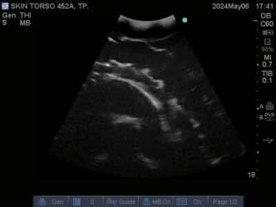 Ultrasound scan of Skin Torso Phantom from True Phantom Solutions