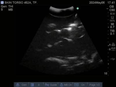 Ultrasound scan of Skin Torso Phantom from True Phantom Solutions