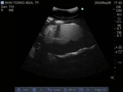 Ultrasound scan of Skin Torso Phantom from True Phantom Solutions