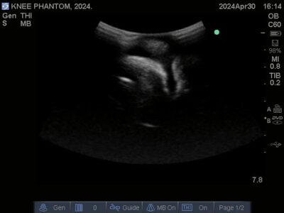 Ultrasound scan of Knee Phantom from True Phantom Solutions