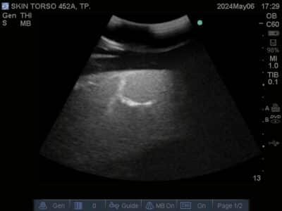 Ultrasound scan of Skin Torso Phantom from True Phantom Solutions