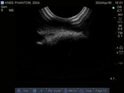 Medial Condyle Femoral (MCL)