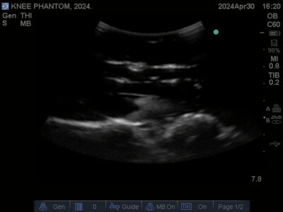 Ultrasound scan of Knee Phantom from True Phantom Solutions