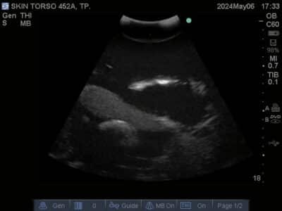 Ultrasound scan of Skin Torso Phantom from True Phantom Solutions