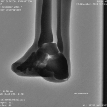 Ankle Internal Rotation