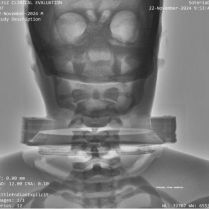 C-Spine Odontoid