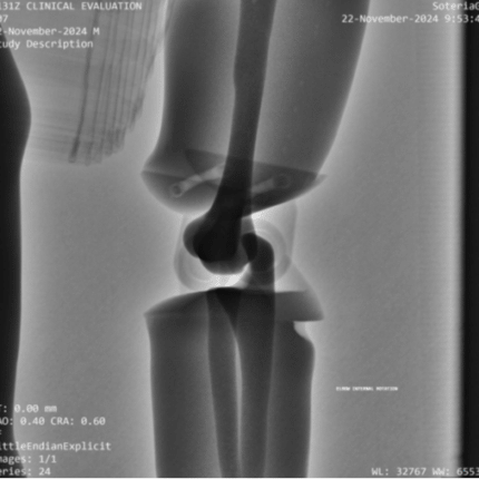 Elbow Internal Rotation