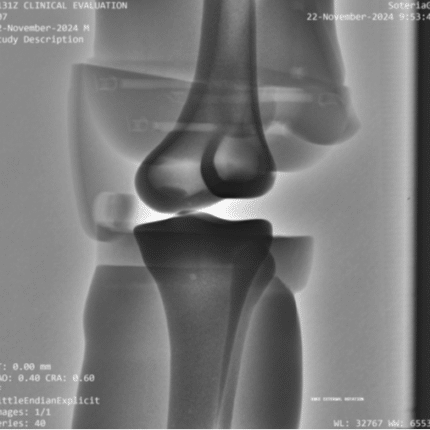 Knee External Rotation