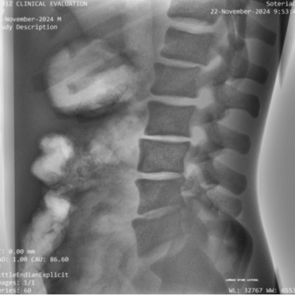 L-Spine LAT